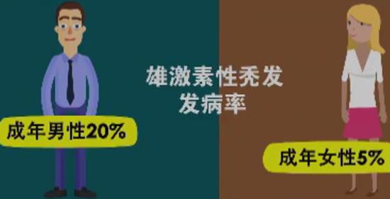 雄激素性秃发发病率