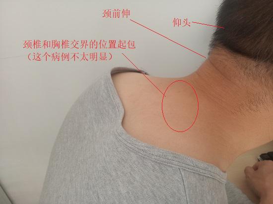 颈前伸与富贵包