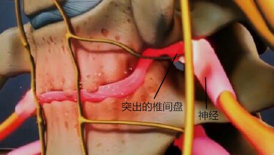 椎间盘压迫神经