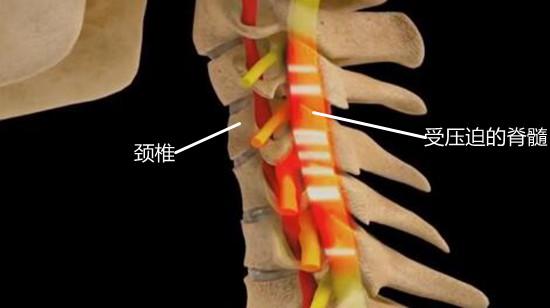 受压迫的脊髓