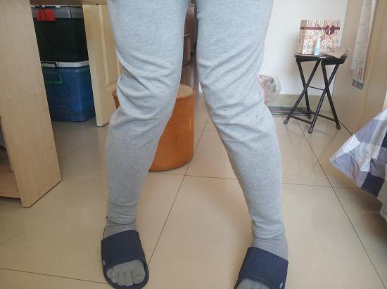 X型腿