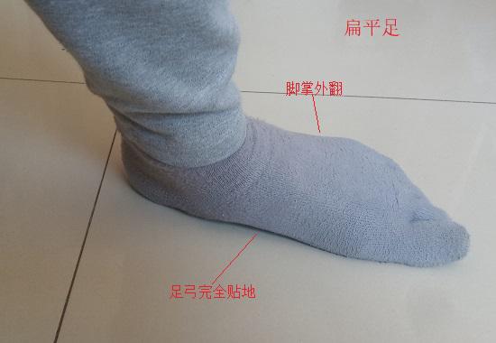扁平足