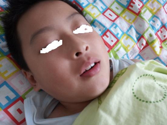 止鼾贴