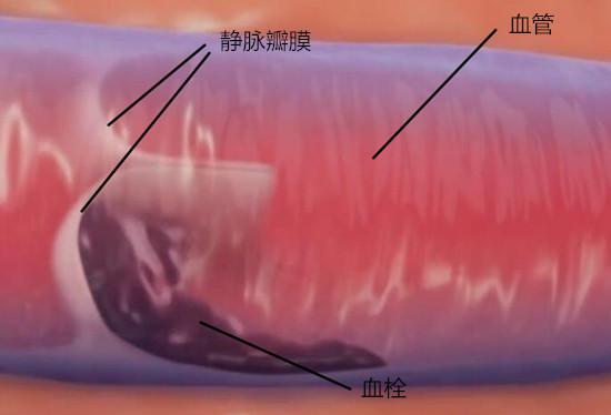 静脉瓣膜