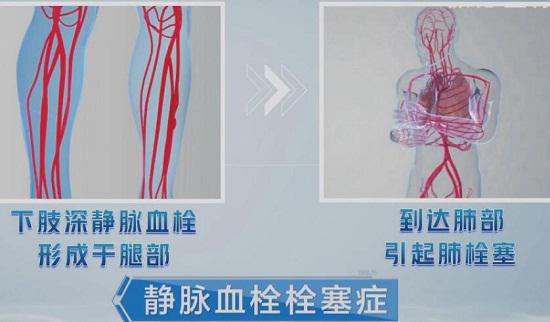 静脉血栓栓塞症