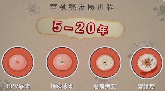 宫颈癌发展进程