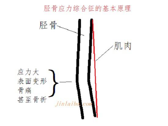 胫骨应力综合征的基本原理