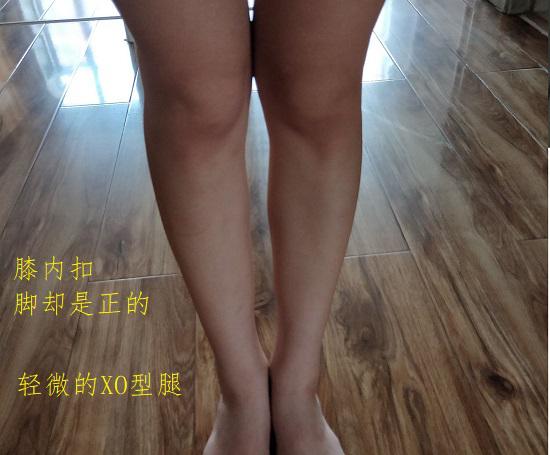 轻微的XO型腿问题