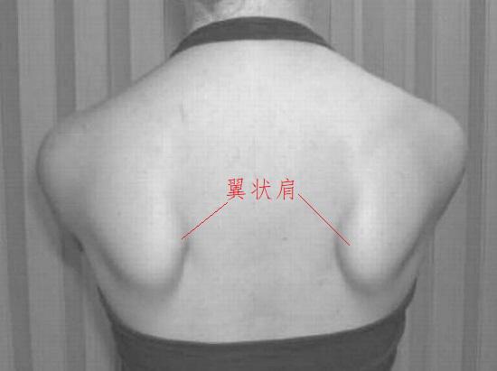 翼状肩