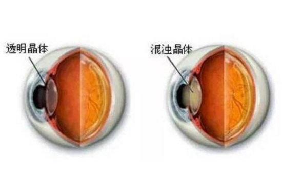 白内障