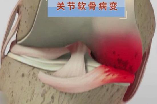 关节软骨病变