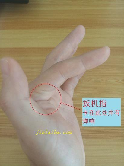 扳机指的症状