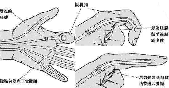 扳机指的病理