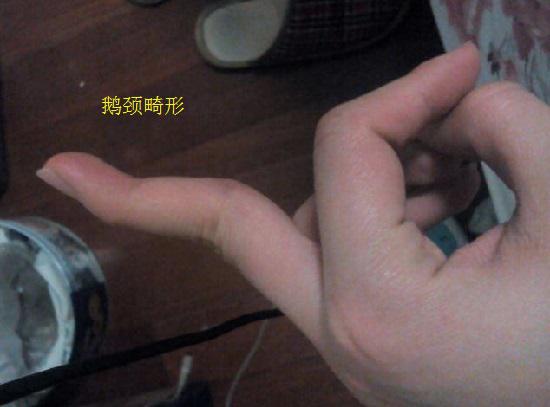骨折或肌腱损伤引发的手部畸形