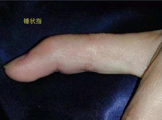 锤状指