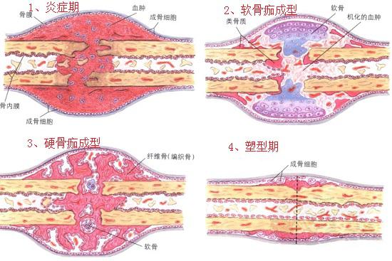 骨折愈合的四个阶段