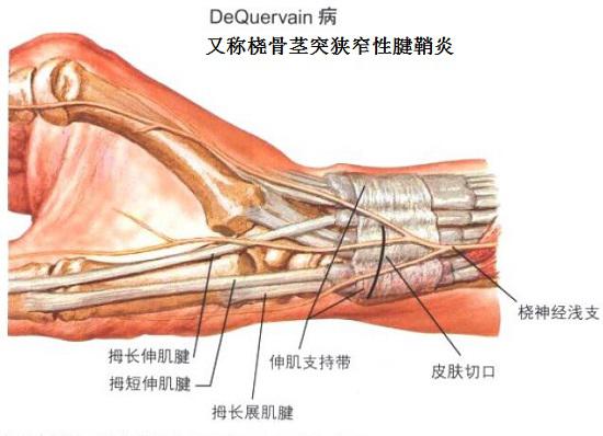 桡骨茎突狭窄性腱鞘炎的手术治疗切口