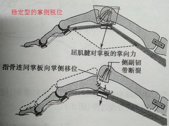 稳定性骨折（韧带及骨骼损伤并存）