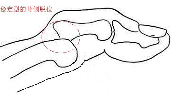 背侧脱位