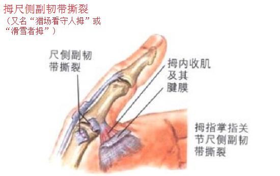 拇尺侧副韧带撕裂