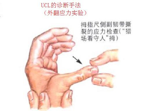 拇尺侧副韧带撕裂的诊断手法