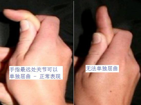 球衣指的症状