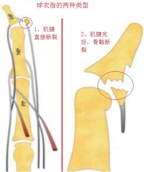 球衣指的两种类型