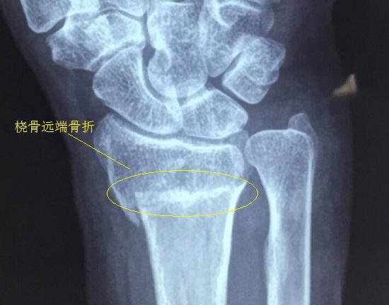 桡骨远端骨折