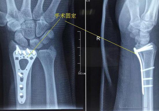 桡骨远端骨折的手术固定