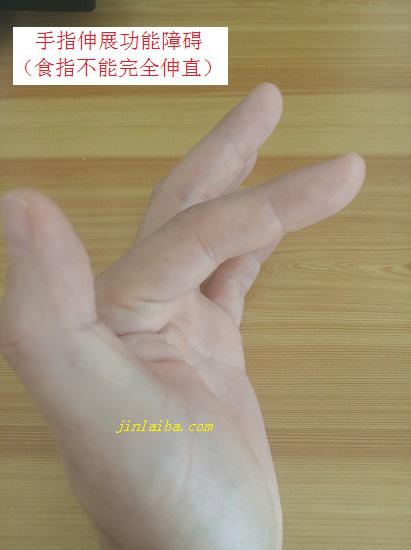 手指伸展功能障碍