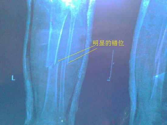 骨折