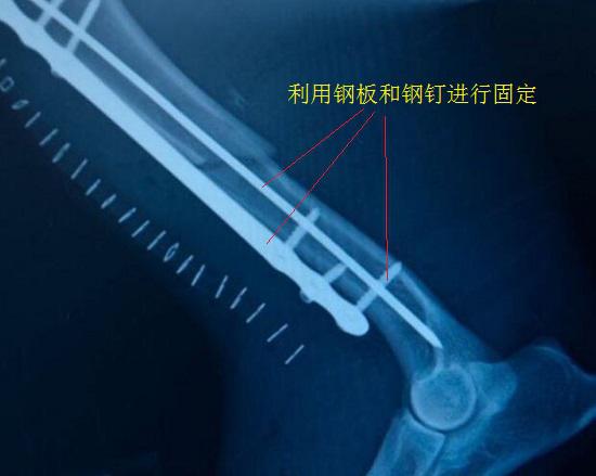 骨折