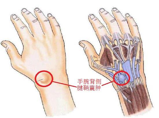 手腕背侧腱鞘囊肿
