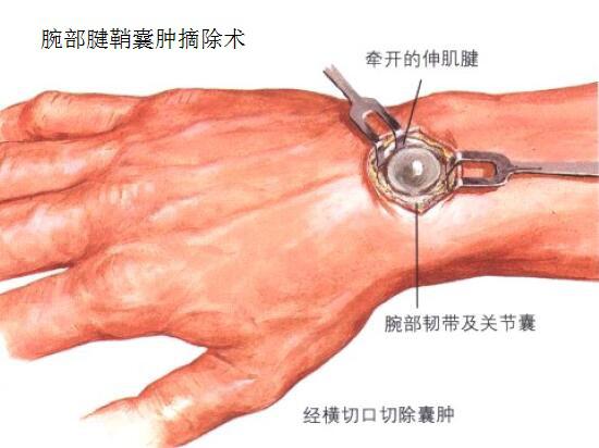 腕部腱鞘囊肿摘除术