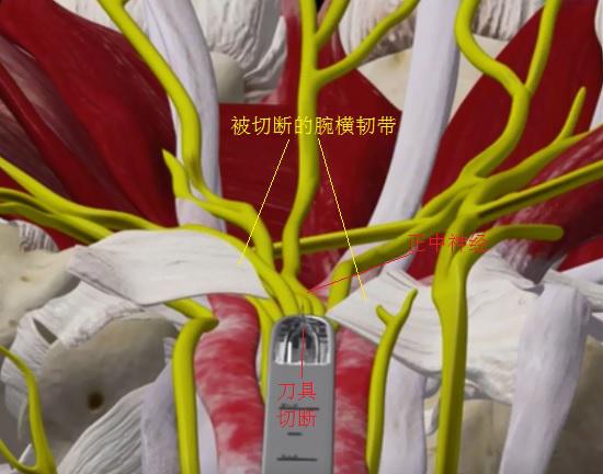 切断腕横韧带