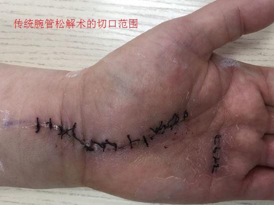 传统松解术的刀口位置