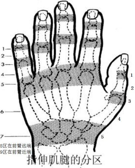手指伸肌腱损伤的区域划分