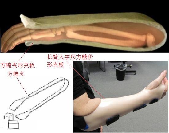 长臂人字形方糖夹形夹板