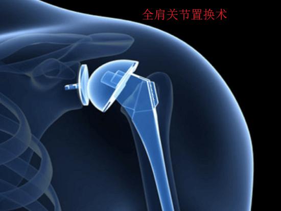 全肩关节置换术