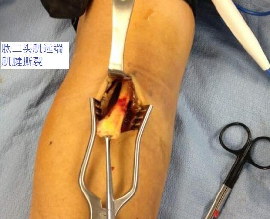 肱二头肌远端肌腱断裂