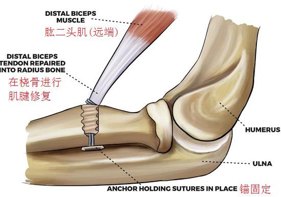 肱二头肌远端肌腱断裂后固定术