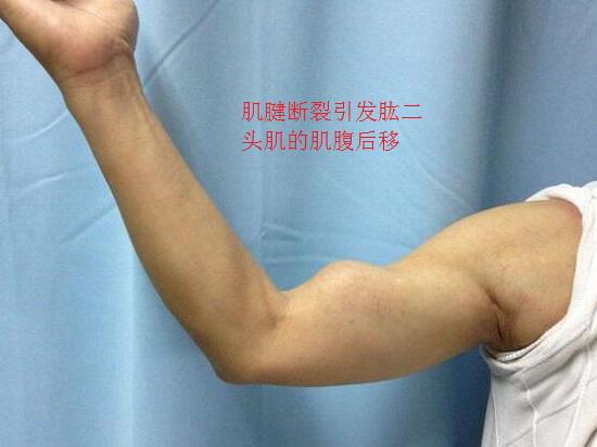 肌腱断裂的后果