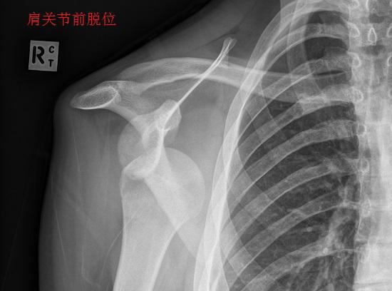 肩关节前脱位的影像资料