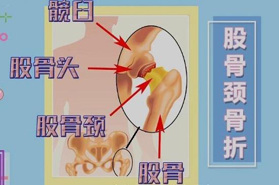 髋骨骨折