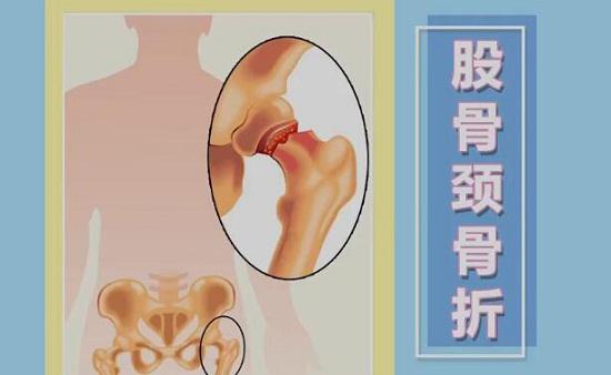髋骨骨折