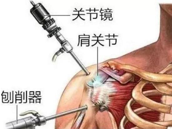 肩关节的关节镜手术