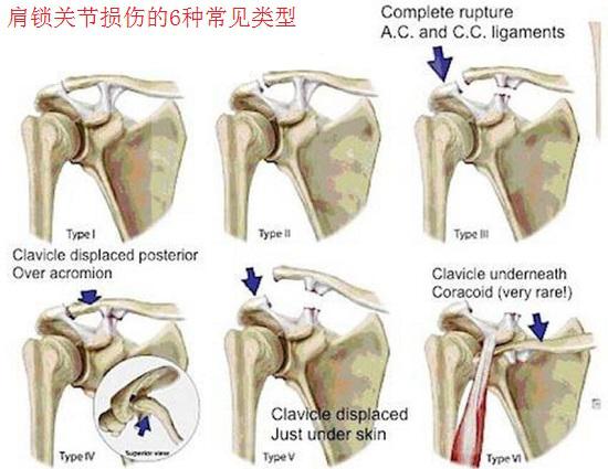 肩锁关节损伤的6种常见类型