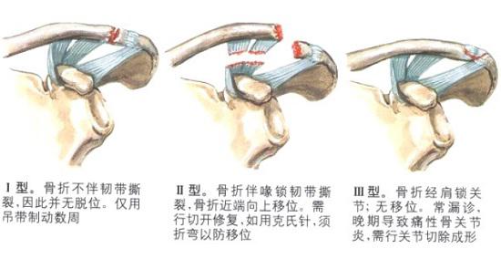 锁骨骨折的几种常见类型
