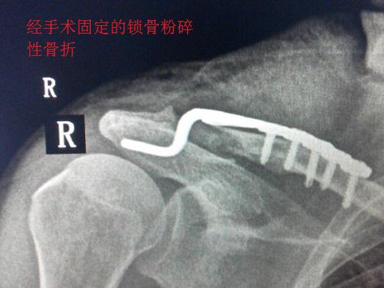 手术固定后的肩锁关节