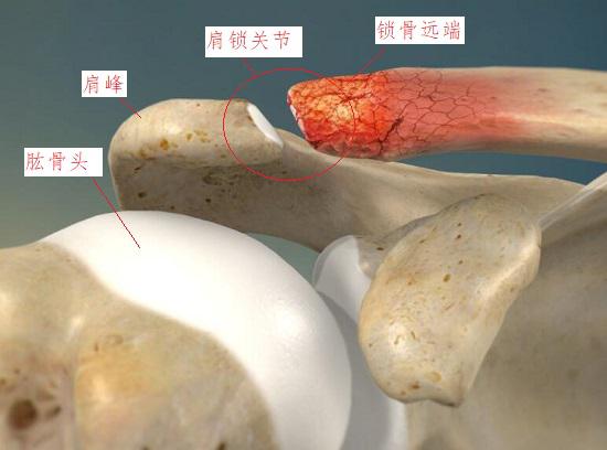 锁骨远端骨溶解的病理现象